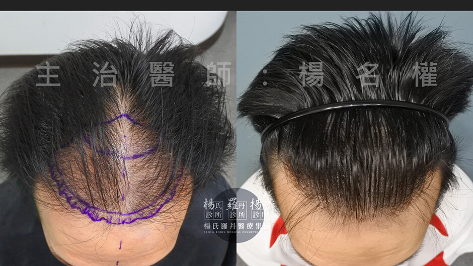 植髮 植髮機器 楊氏  禿頭  掉髮